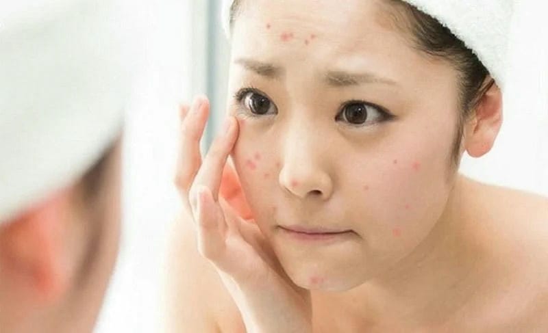 Giải mã nguyên nhân - Tại sao mụn lại "tấn công" tuổi dậy thì?