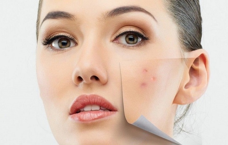 Những "Hoạt Chất Vàng" Cho Làn Da Mụn