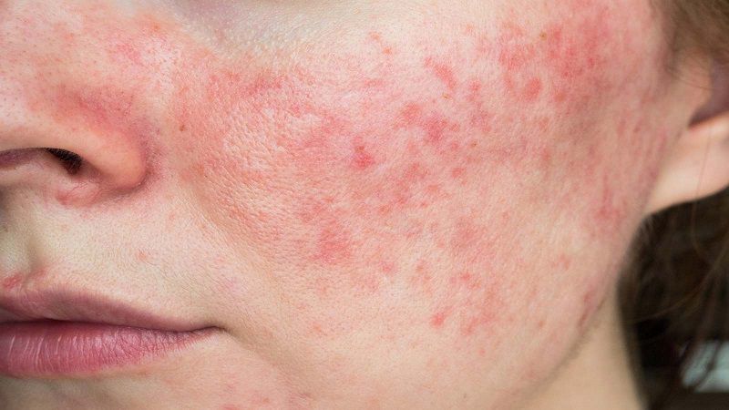 Chu trình phục hồi cần ưu tiên các thành phần làm dịu da như B5, Rau má và Hyaluronic Acid.
