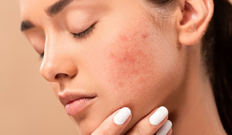 Dấu hiệu da bị kích ứng mỹ phẩm thường biểu hiện qua phản ứng nổi mẩn, đỏ rát trên bề mặt.