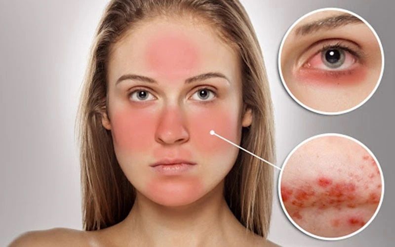 Khi thấy biểu hiện sưng tấy hoặc mọc mụn mủ bất thường, bạn cần dừng ngay mọi sản phẩm chứa hoạt chất mạnh.