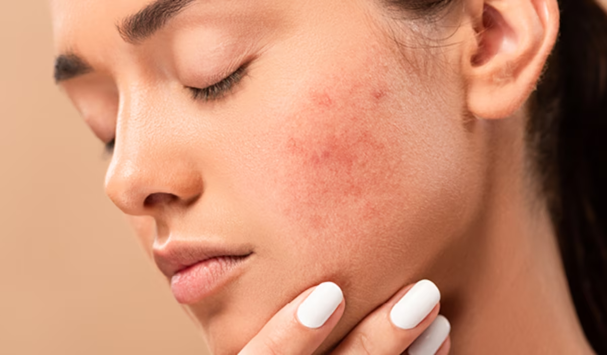 Làn da dễ gặp tình trạng đỏ rát, bong tróc và suy yếu khi sử dụng các hoạt chất treatment.