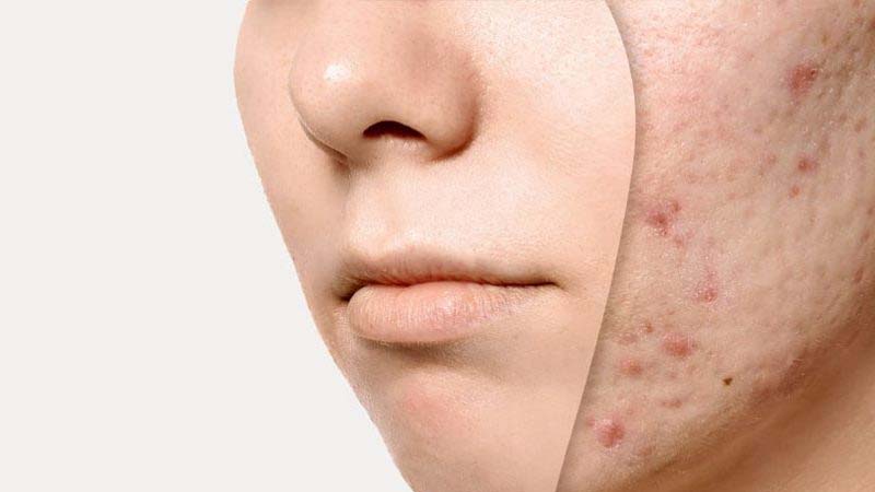 Tổng quan về mụn ẩn và cơ chế tác động của Acid