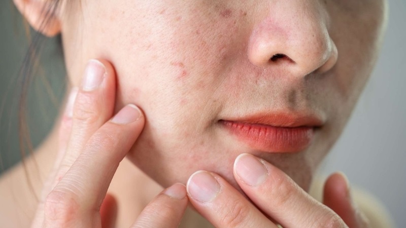 Dấu Hiệu Nhận Biết Và Nguyên Nhân Khiến Da Bị Kích Ứng