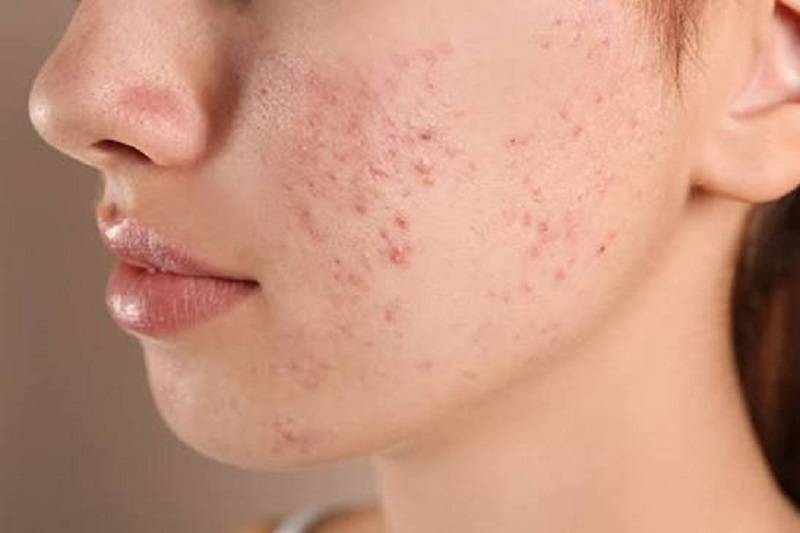 Nguyên Tắc Vàng Khi Chăm Sóc Da Đang Bị Tấy Đỏ, Nhạy Cảm